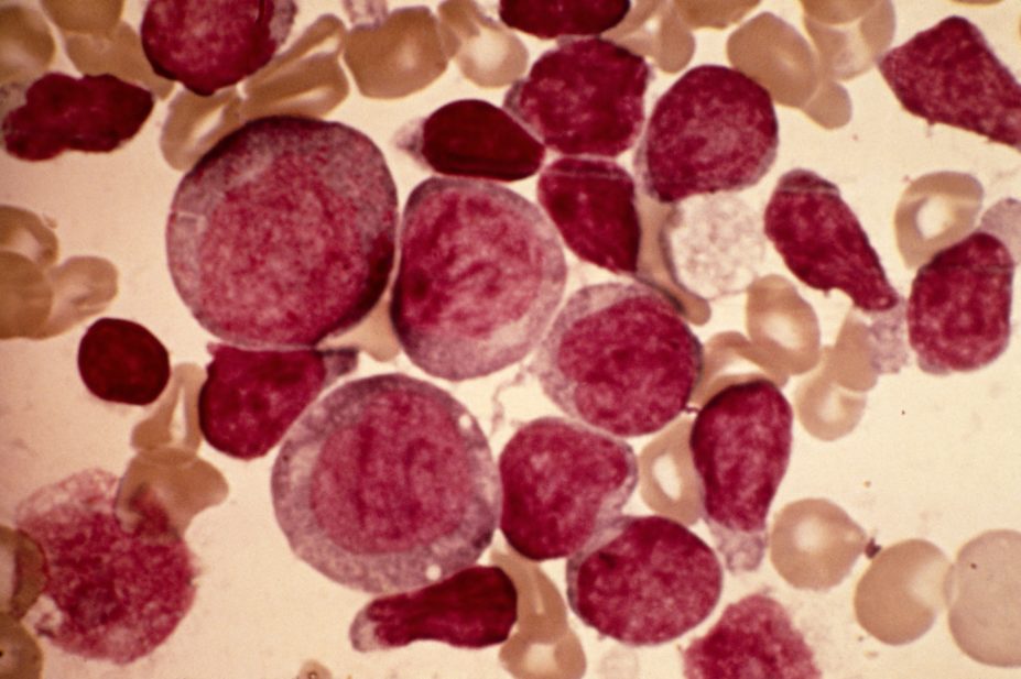 Light micrograph of blood cells from bone marrow in a case of acute leukaemia