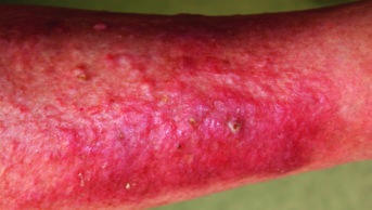 severe atopic dermatitis