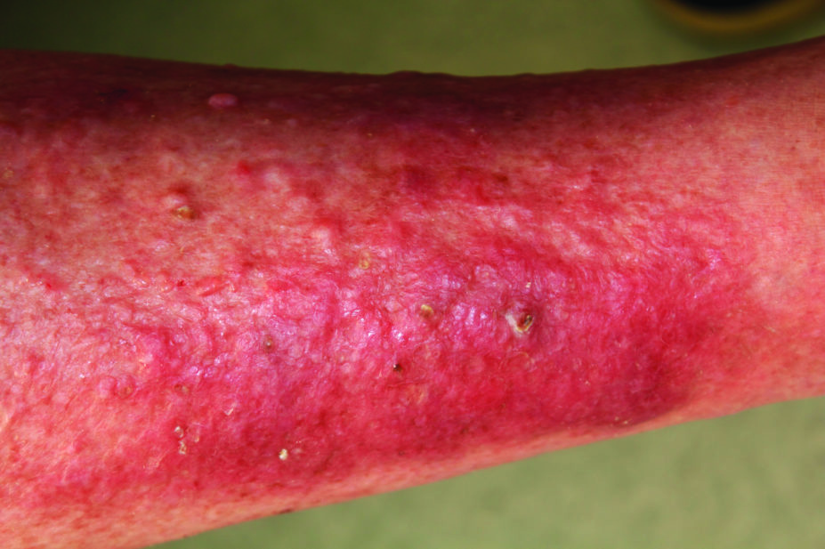 severe atopic dermatitis