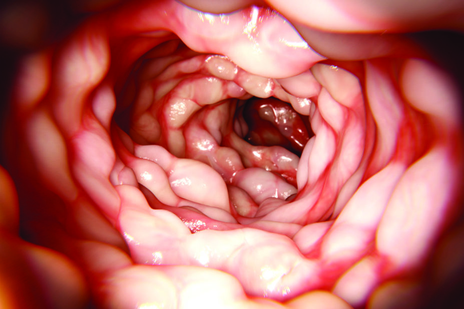 Intestine affected by Crohn's disease