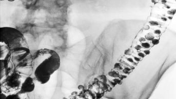 Diverticulitis X ray