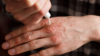 Emollient being put on hand with psoriasis