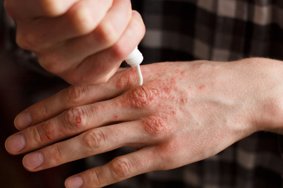 Emollient being put on hand with psoriasis