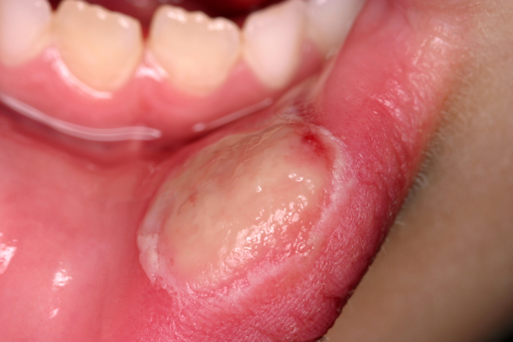 Oral ulceration: causes and management - The Pharmaceutical Journal