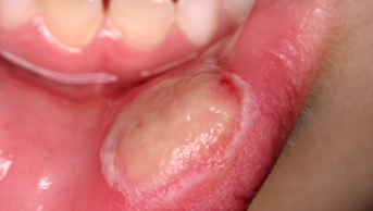 Image of a traumatic ulcer