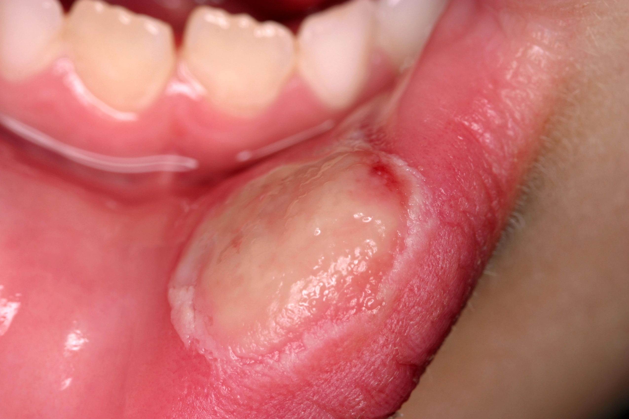 ulcer on floor of mouth