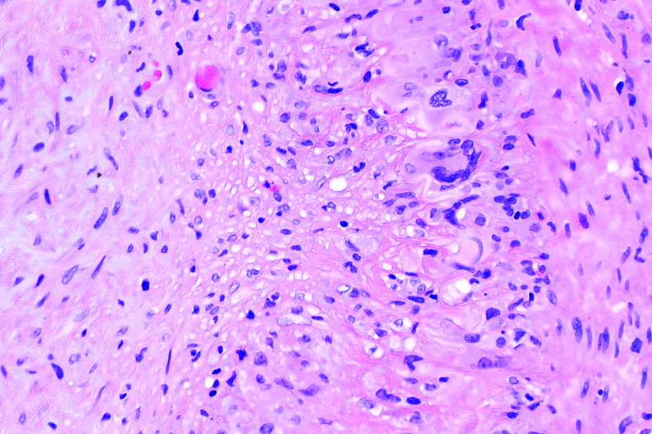 histology stain showing giant cell arteritis