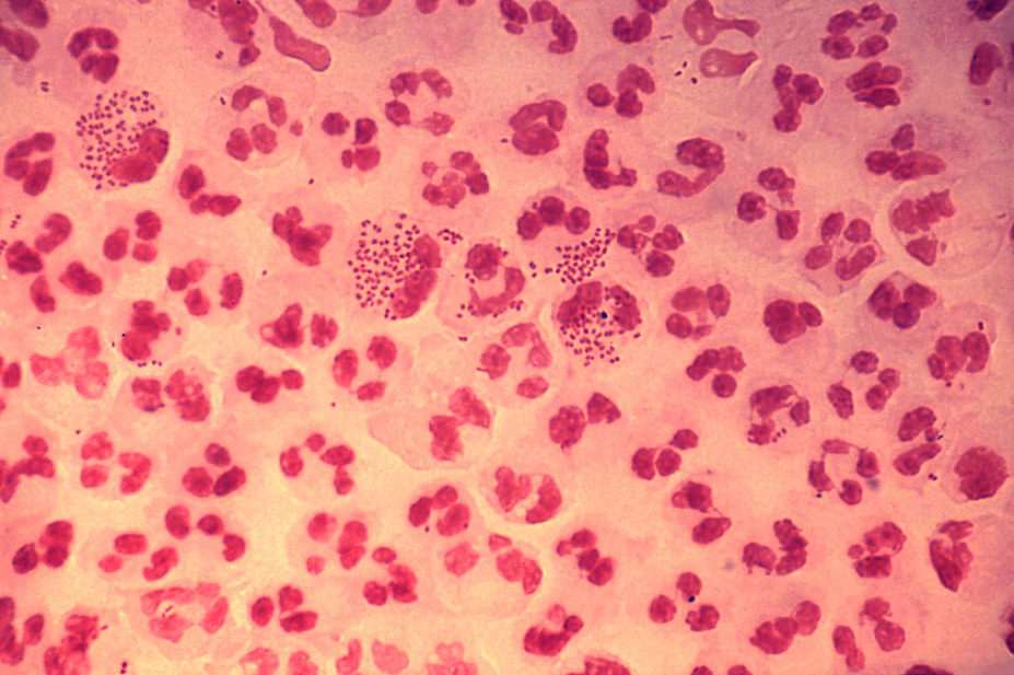 This photomicrograph reveals the histopathology in an acute case of gonococcal urethritis using Gram-stain technique