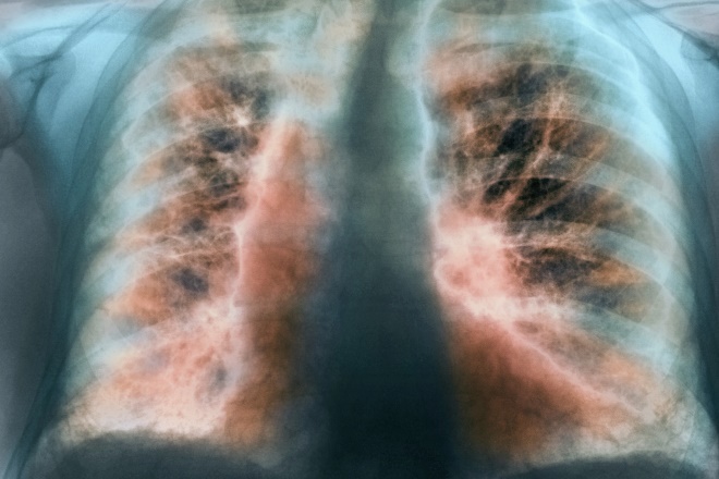 Image of "A false-colour X-ray showing idiopathic pulmonary fibrosis, a condition where the lung's alveoli gradually thicken and scar owing to chronic, progressive inflammation"