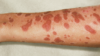 Early lesions from Stevens–Johnson syndrome