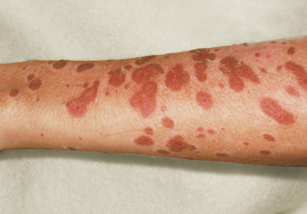 Early lesions from Stevens–Johnson syndrome