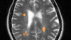 MRI of multiple sclerosis in a 42 year old woman