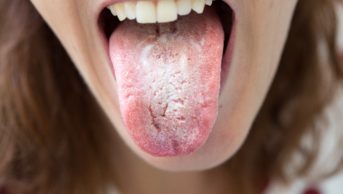 Oral candidiasis: causes, types and treatment