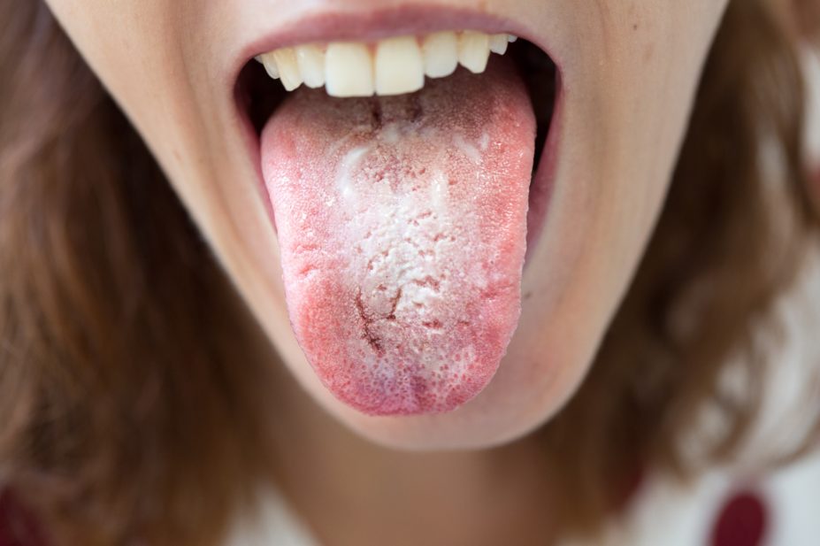 Oral candidiasis: causes, types and treatment