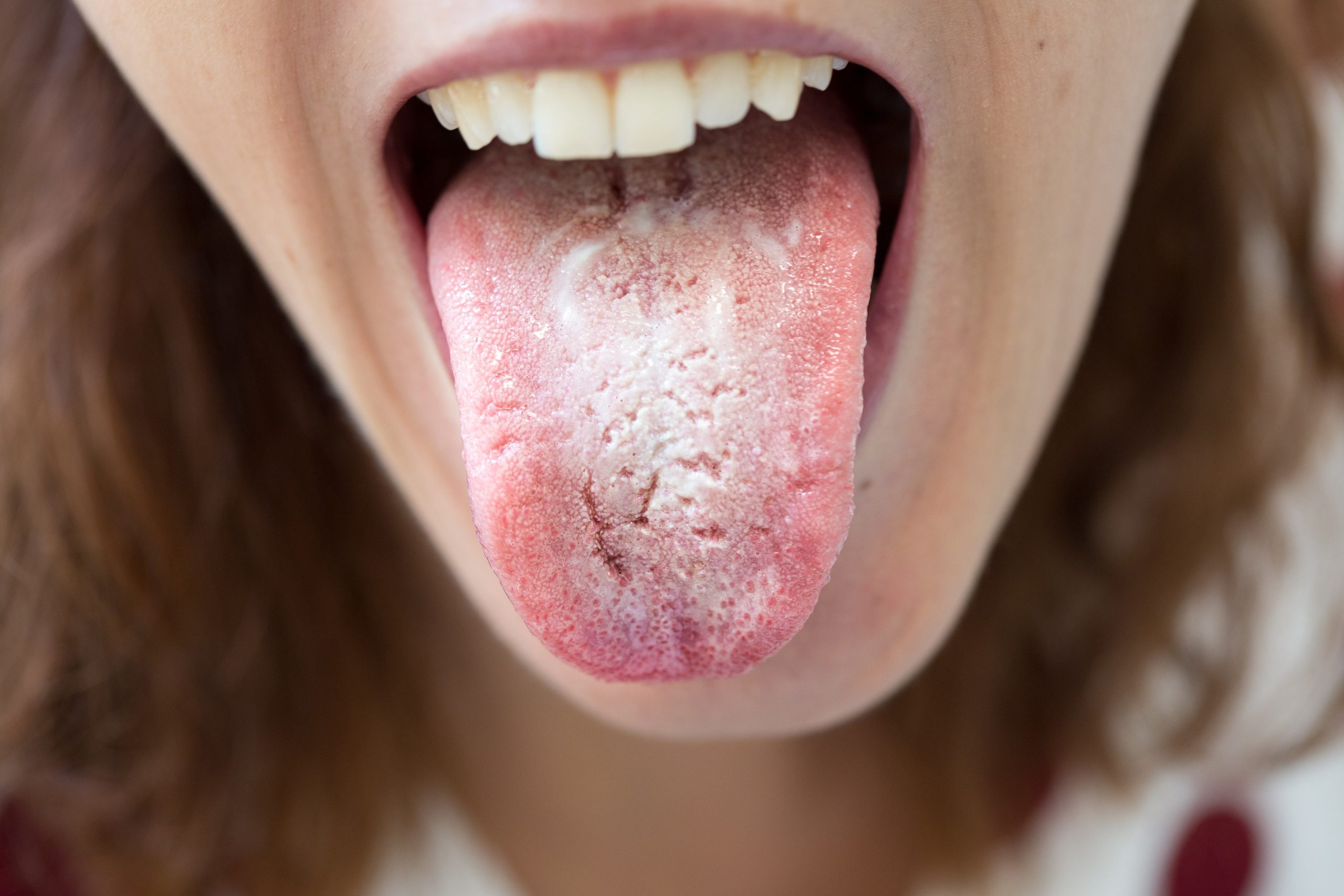Oral candidiasis: causes, types and treatment - The Pharmaceutical Journal