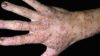 Oral therapy abrocitinib effective in moderate to severe atopic dermatitis