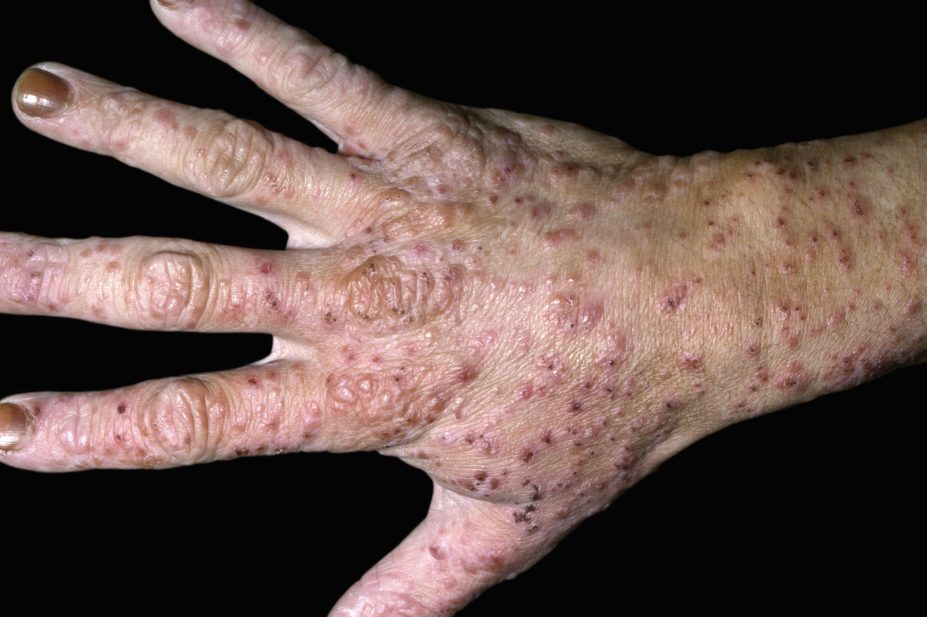 Oral therapy abrocitinib effective in moderate to severe atopic dermatitis