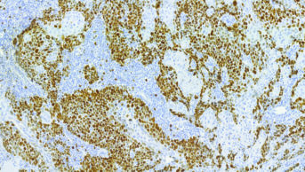 Tumour sample slide showing aggressive tumour