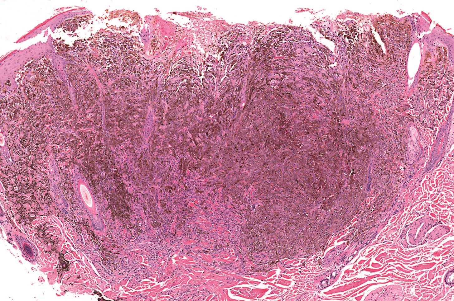 Penbro Rash Pembrolizumab endorsed as melanoma therapy by NICE - The Pharmaceutical ...