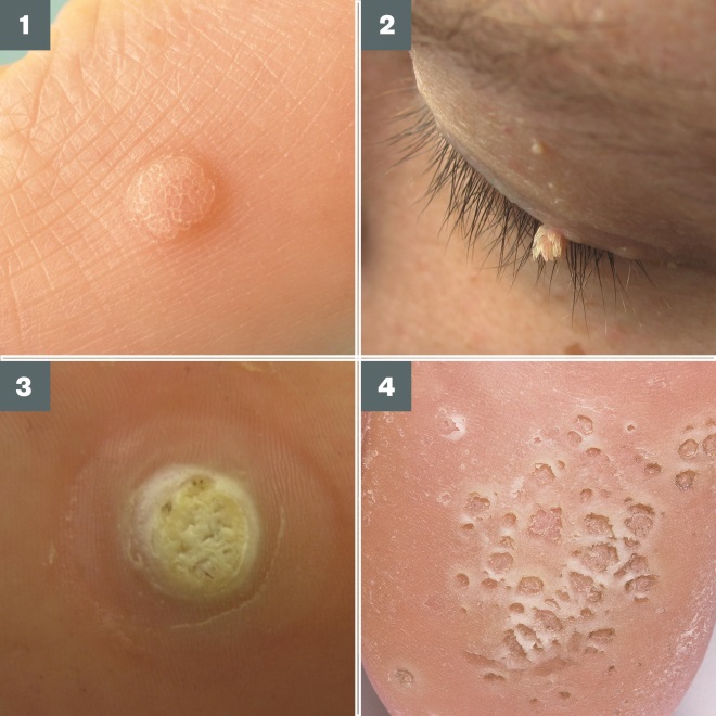 Hpv on your face - Pin on Sanatate Papilloma skin growth