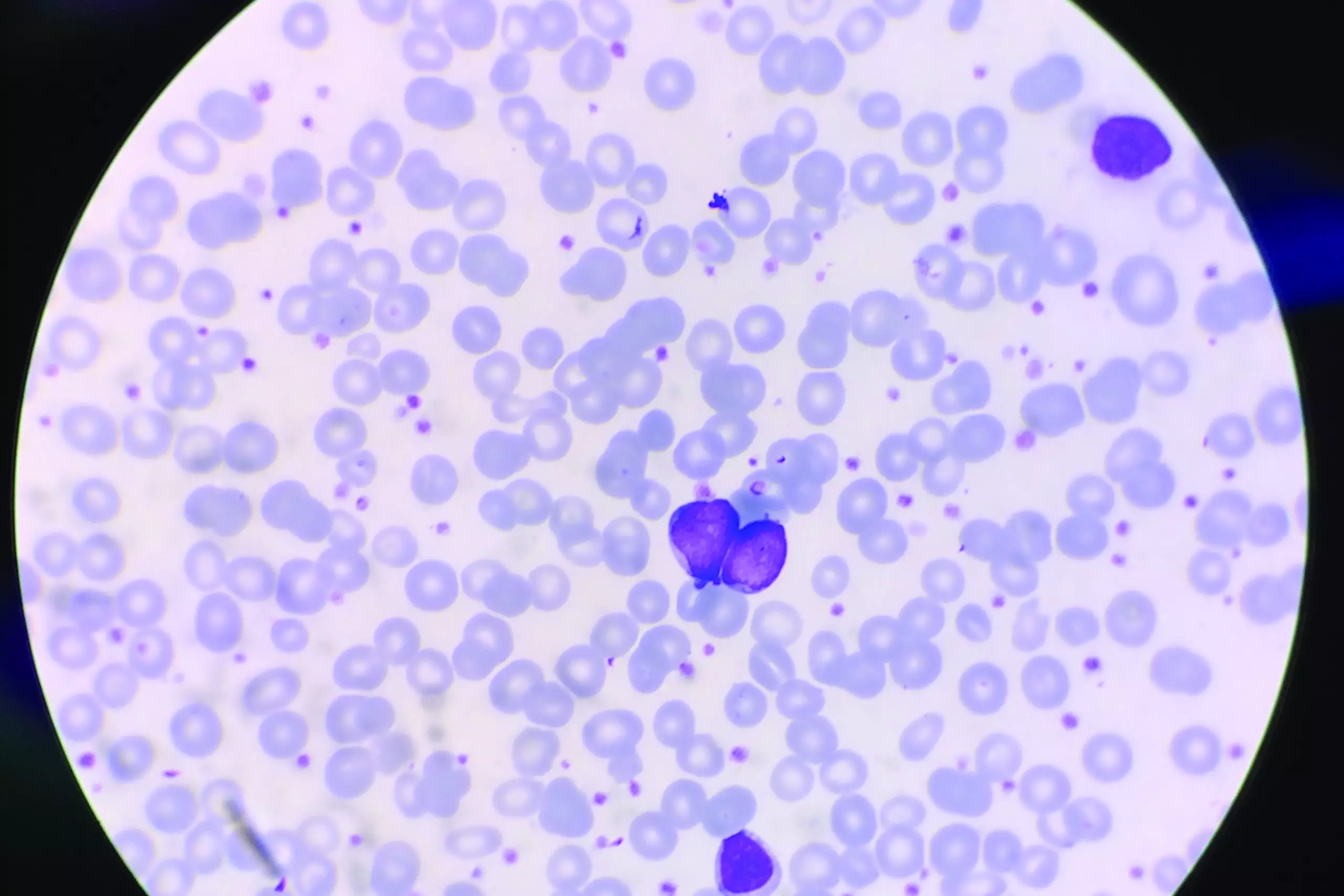 High Platelet Count And High Eosinophils