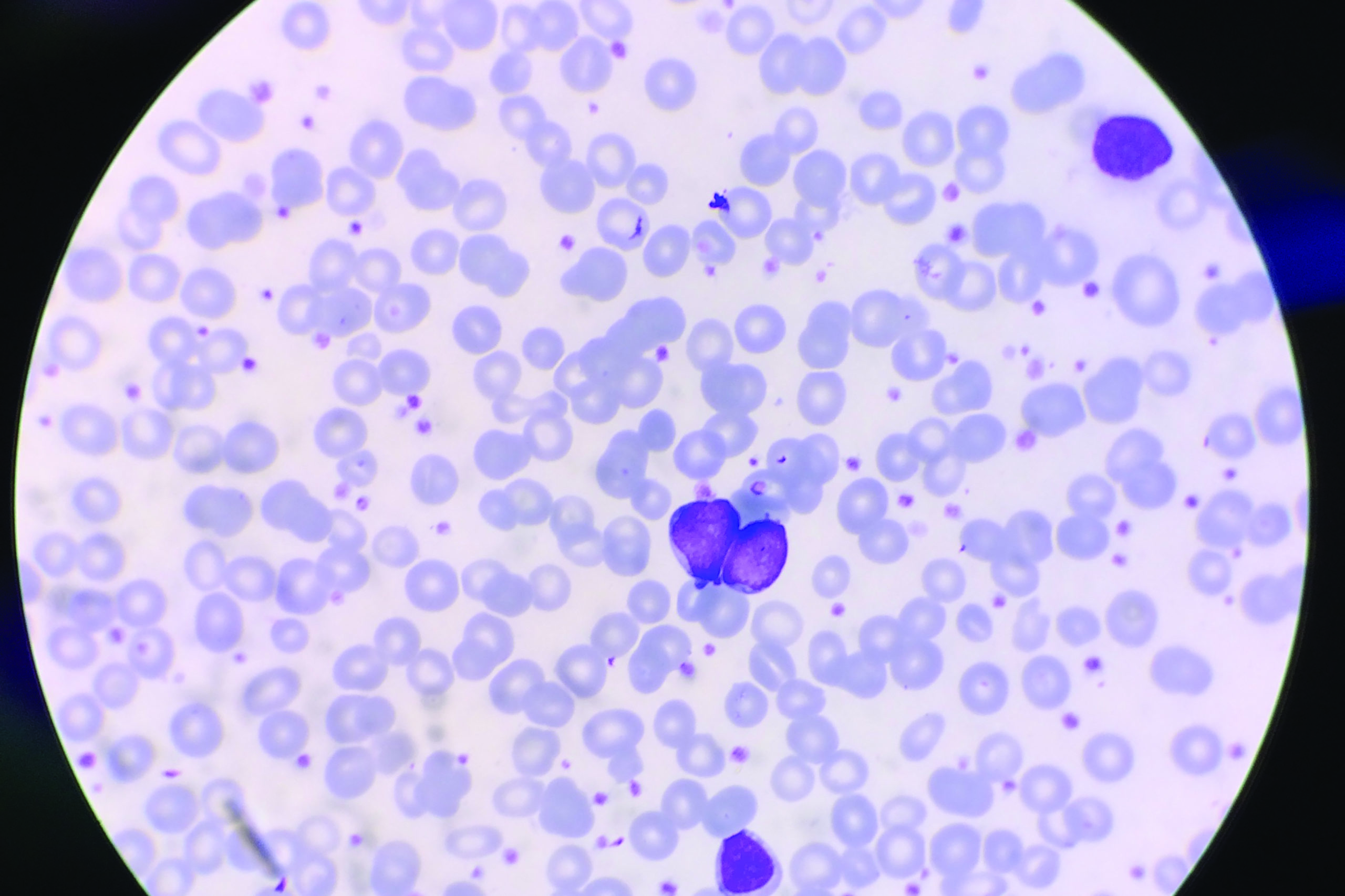 Patients With High Platelet Counts Should Be Tested For Cancer The 