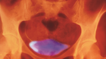 Urogram of urine in normal human bladder