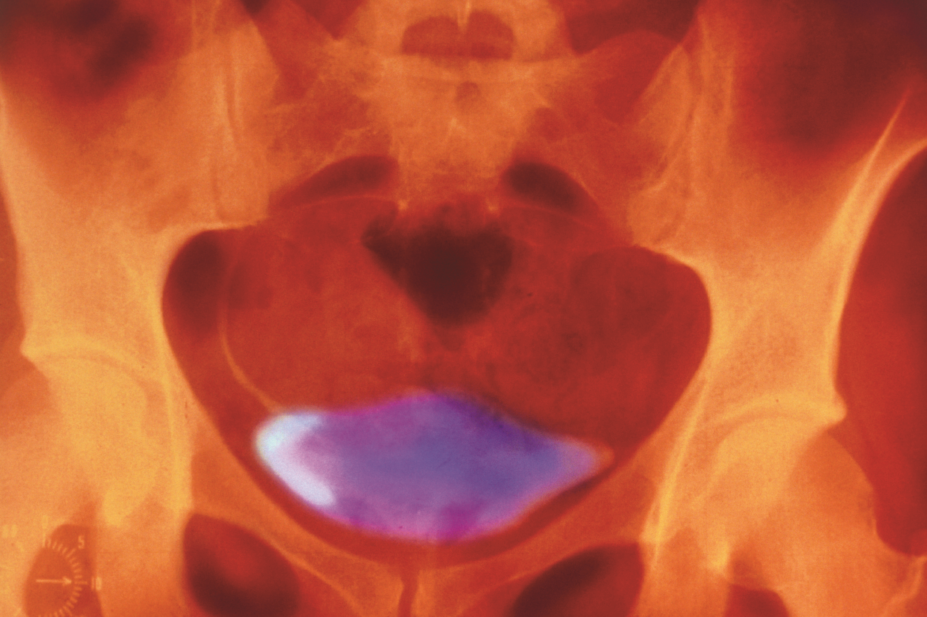 Urogram of urine in normal human bladder