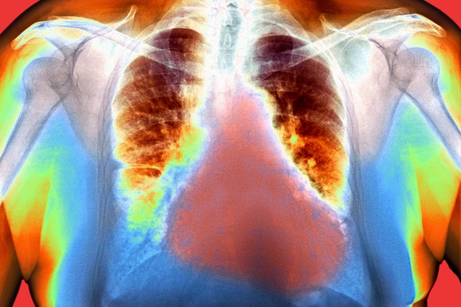 Image of "False-colour chest X-ray of a female patient with severe enlargement of the heart â a condition that can be caused by heart failure"