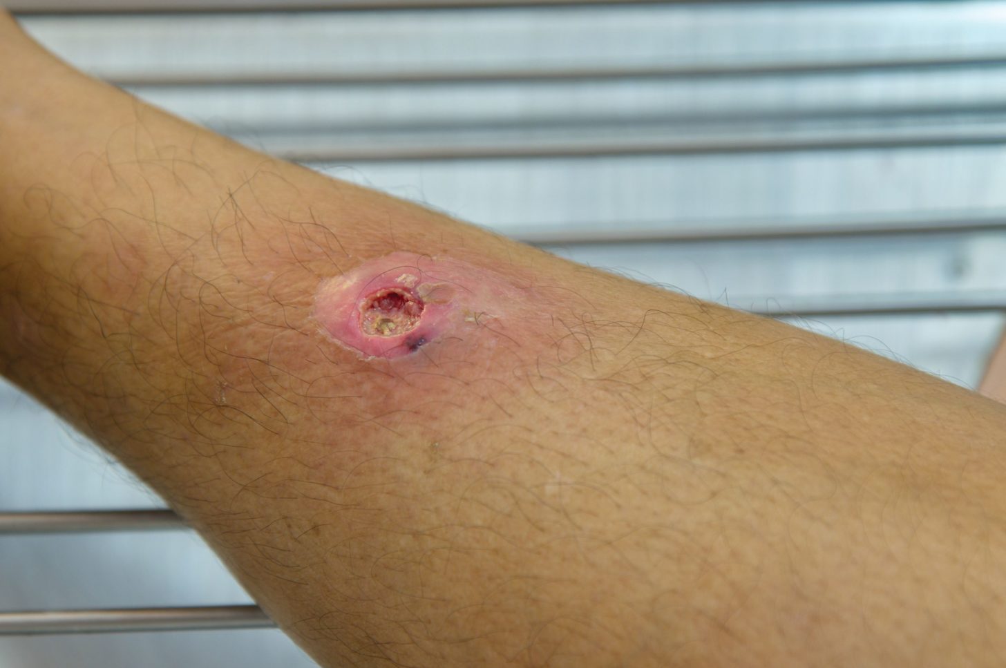 Antibiotics Increase Cure Rate From Small Skin Abscesses Compared With