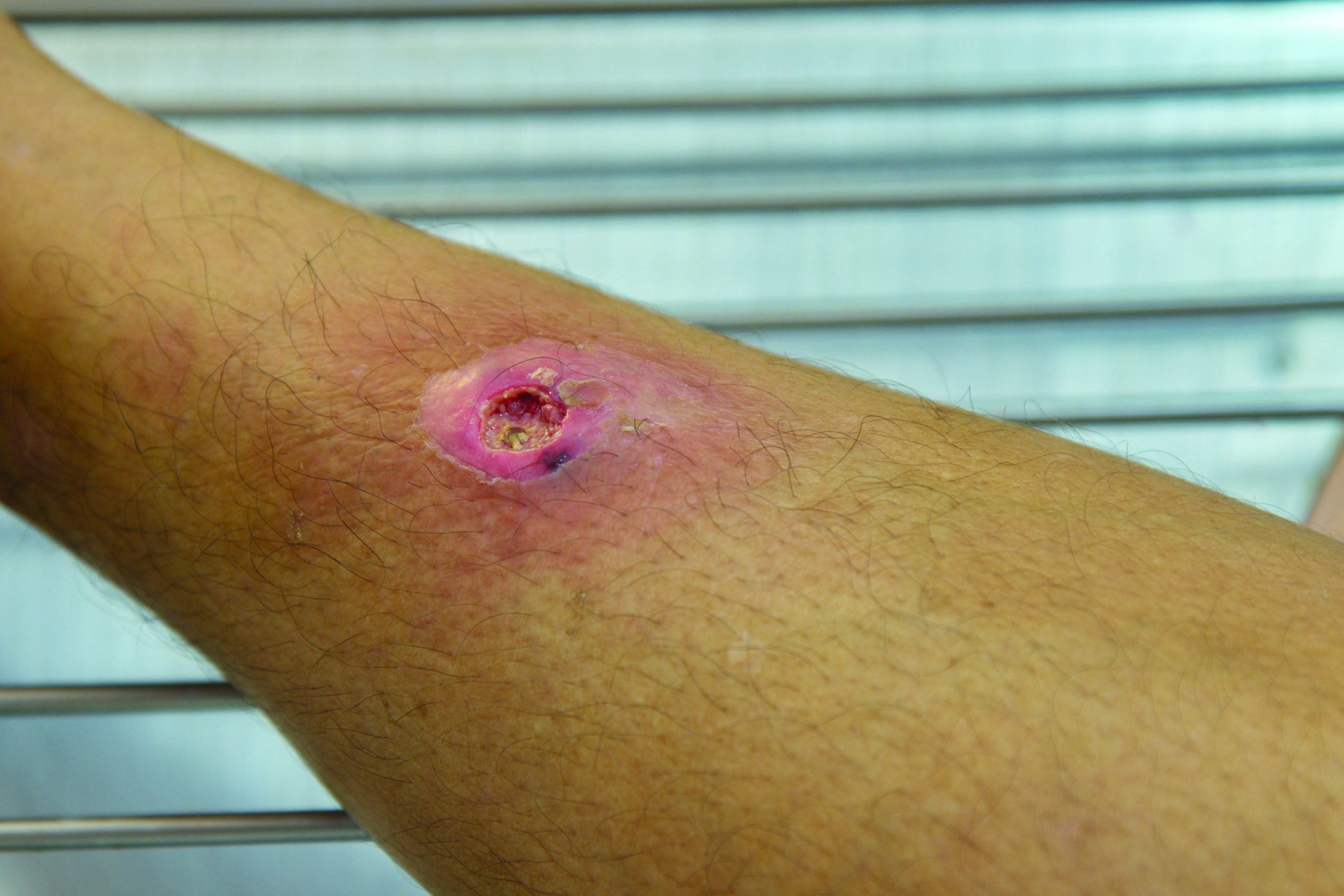 Antibiotics Increase Cure Rate From Small Skin Abscesses Compared With 