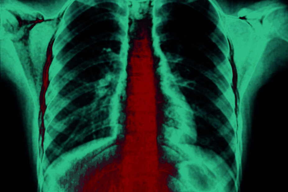Xray of acid reflux causing chest pain