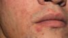 Close up of acne