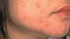 Patients who are receiving oral isotretinoin for acne do not need to be monitored with monthly blood tests, say the authors of a meta-analysis. In the image, close-up of a teenager's jawline with acne