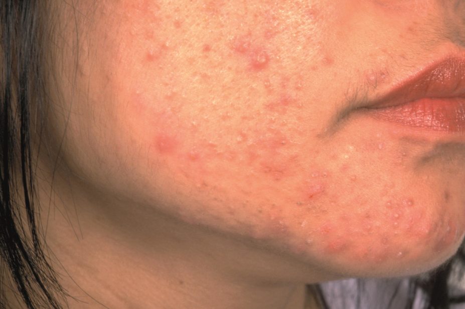 Patients who are receiving oral isotretinoin for acne do not need to be monitored with monthly blood tests, say the authors of a meta-analysis. In the image, close-up of a teenager's jawline with acne