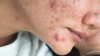 Acne, close up woman's face