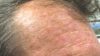 Picato gel, used to treat actinic keratosis (pictured on balding man's forehead), has been linked with shingles, severe allergic reactions, eye injuries and skin reactions when used incorrectly, the FDA warns