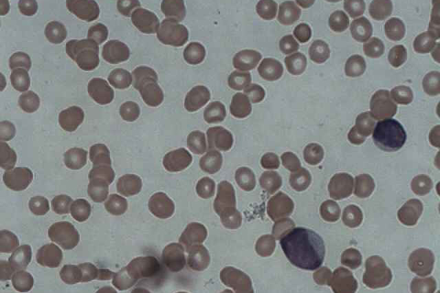 Acute myeloid leukaemia micrograph