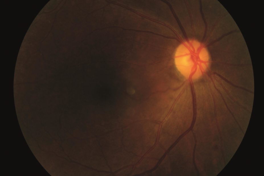 The anticonvulsant drug phenytoin, usually used in epilepsy, can help prevent nerve damage caused by acute optic neuritis (pictured) in patients with multiple sclerosis (MS), according to recent research