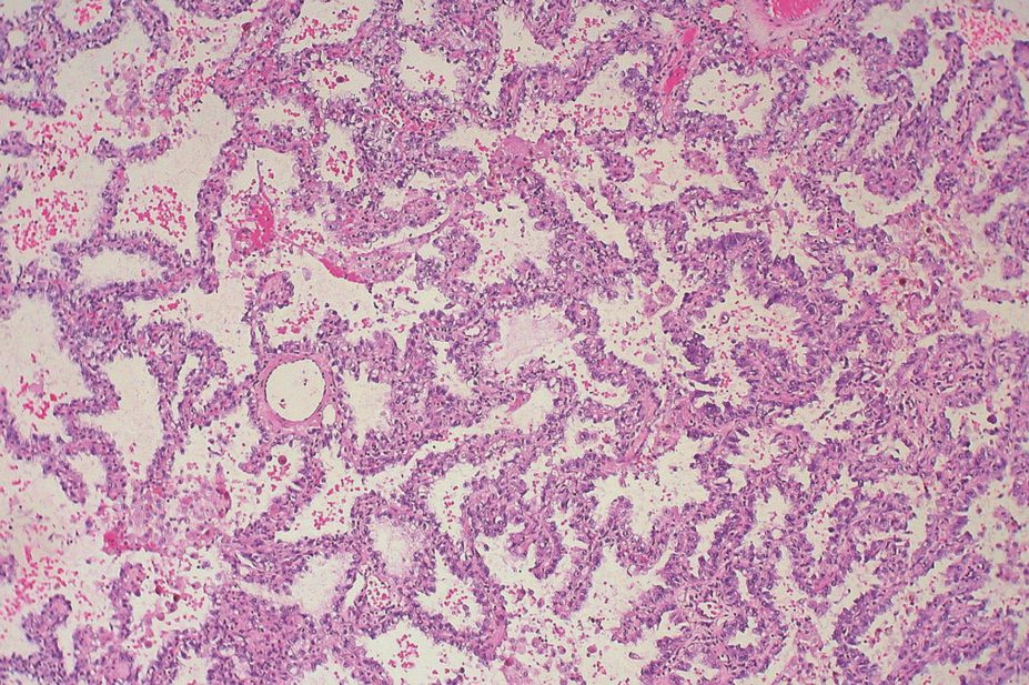 Lipophilic bisphosphonates, originally used to treat osteoporosis, has demonstrated efficacy against lung adenocarcinoma (pictured).