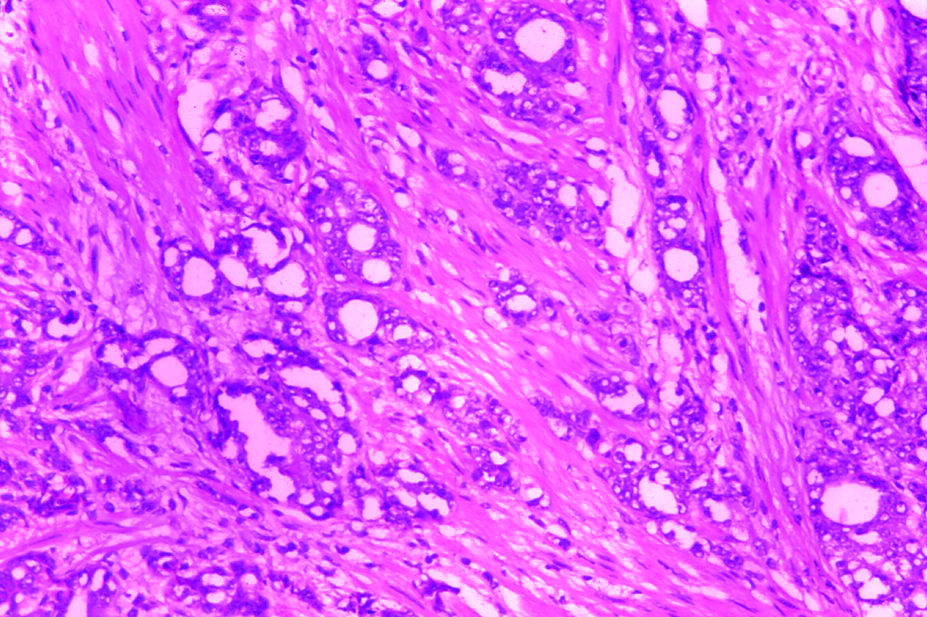 Micrograph of adenocarcinoma in the prostate