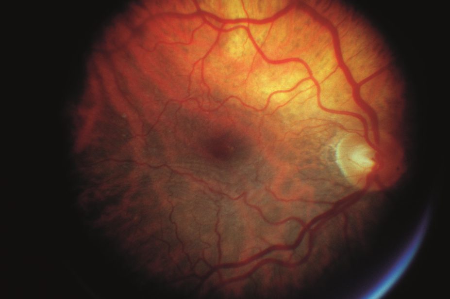 Peptide-like drug candidate has the potential to provide a safer, less-invasive approach to treating pathological angiogenesis in retinal disorders. In the image, ophthalmoscope image of age-related macular degeneration (AMD)