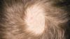 Researchers have found that an existing class of drugs called JAK inhibitors can reactivate hair follicle stem cells when applied topically. In the image, scalp of a man with alopecia