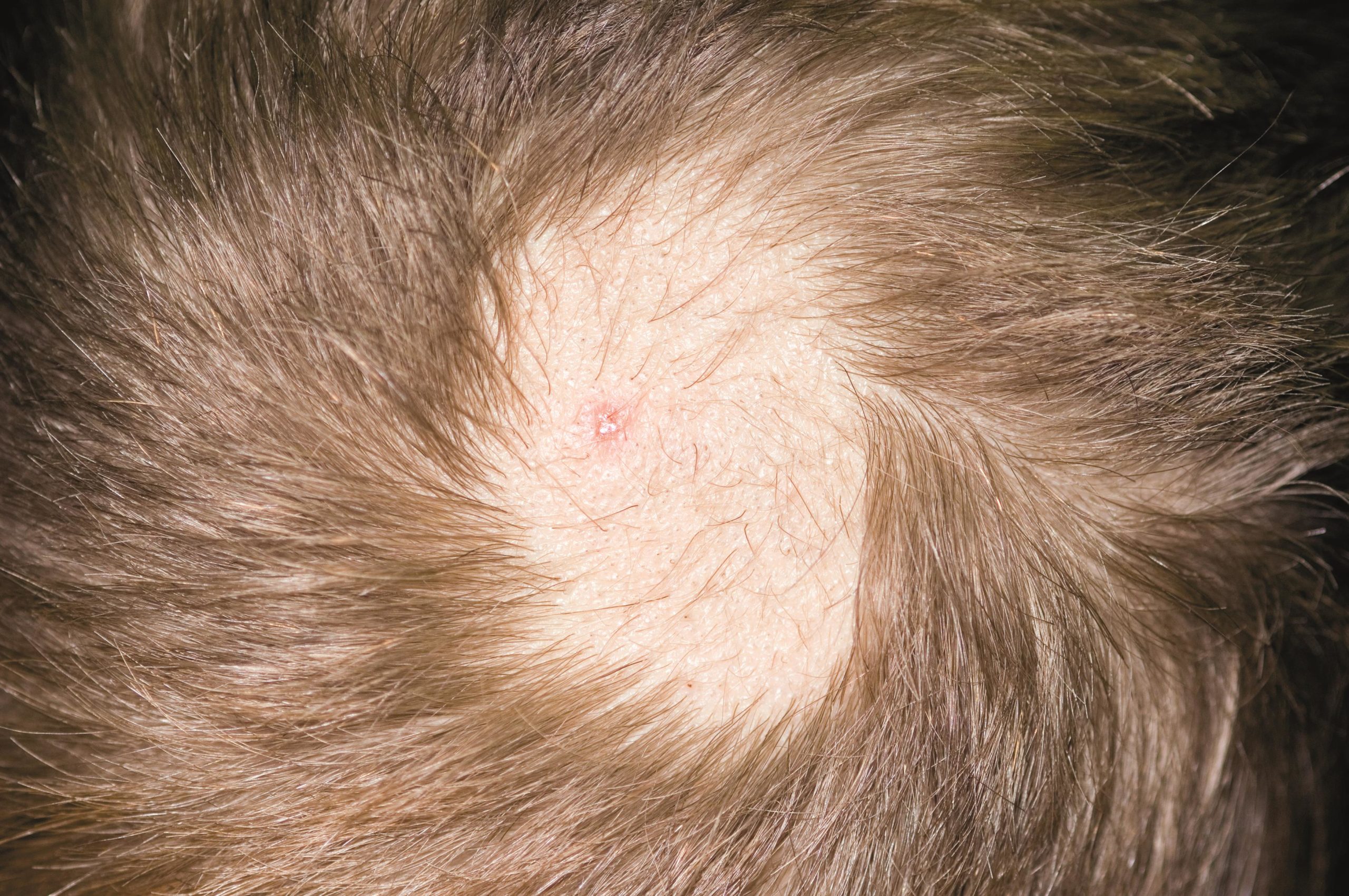 wart on scalp