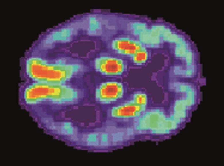 The findings suggest that black alzheimer's disease patients are more likely to have Alzheimer pathology mixed with other pathology, such as Lewy bodies and infarcts.In the image, a PET scan of a patient with Alzheimer's disease