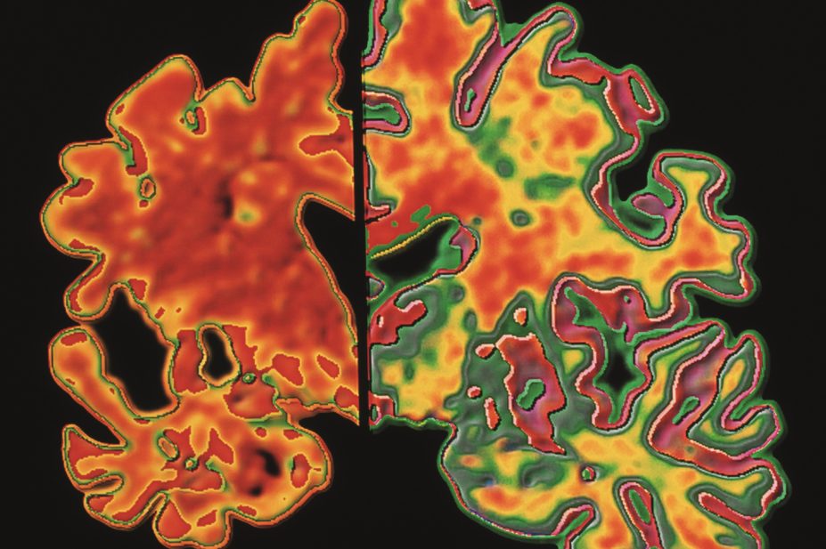 A monoclonal antibody in development for the treatment of Alzheimer’s disease (AD) may have disease-modifying properties, according to new research. In the image, section of a brain with AD (left) and a normal brain (right)