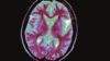 An MRI scan of Alzheimer's disease in the brain