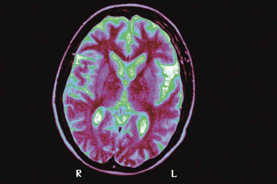 An MRI scan of Alzheimer's disease in the brain
