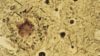 Light micrograph of human brain tissue in Alzheimer's disease showing amyloid plaque (dark-stain)