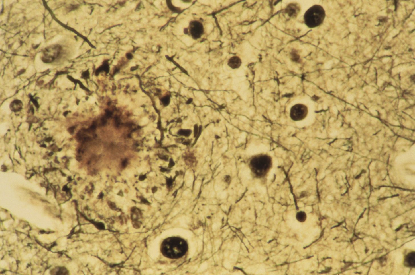 Microscopic image of amyloid plaques in brain tissue